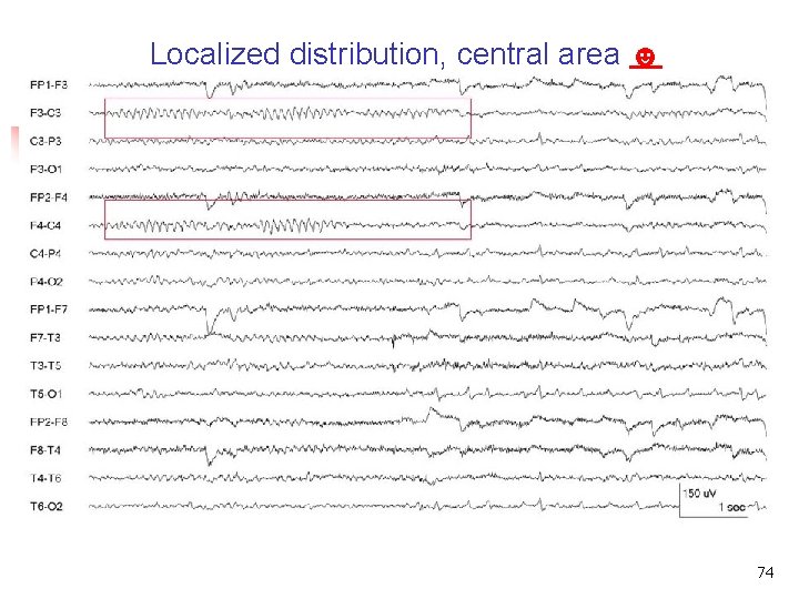 Localized distribution, central area ☻ Focal or localized distribution 74 