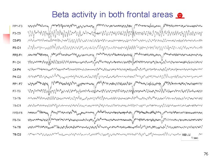 Beta activity in both frontal areas ☻ Beta rhythm 76 