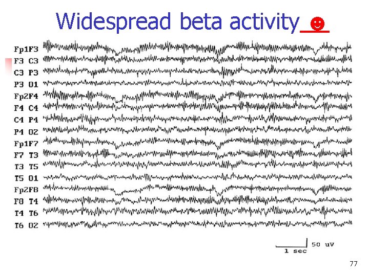 Widespread beta activity ☻ Beta frequency band 77 