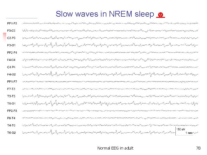 Slow waves in NREM sleep ☻ Slow waves in non-REM sleep Normal EEG in