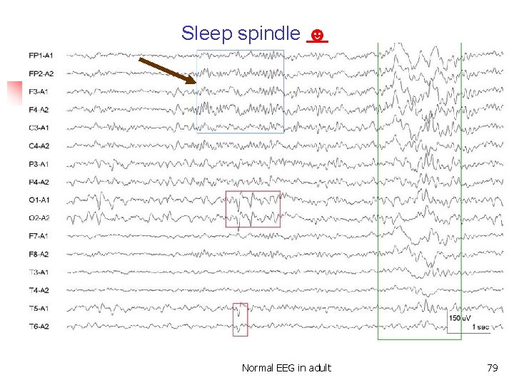 Sleep spindle ☻ Sleep spindle Normal EEG in adult 79 