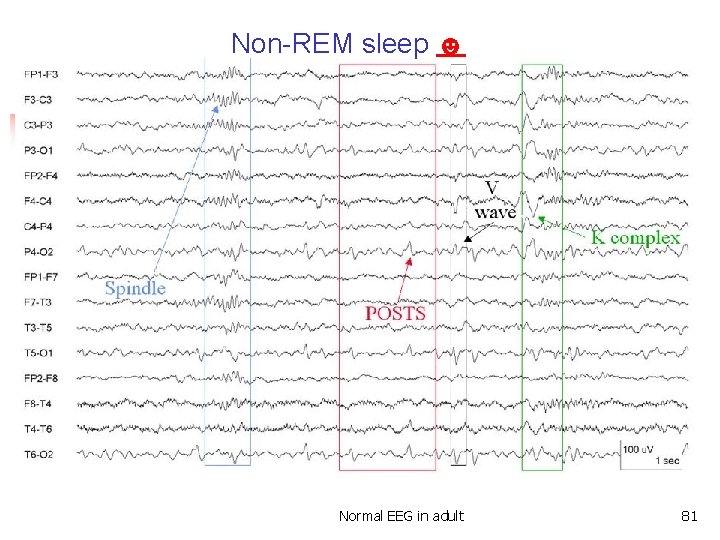 Non-REM sleep ☻ Components of non-REM sleep Normal EEG in adult 81 