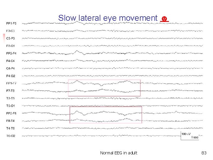 Slow lateral eye movement ☻ Slow lateral eye movements Normal EEG in adult 83