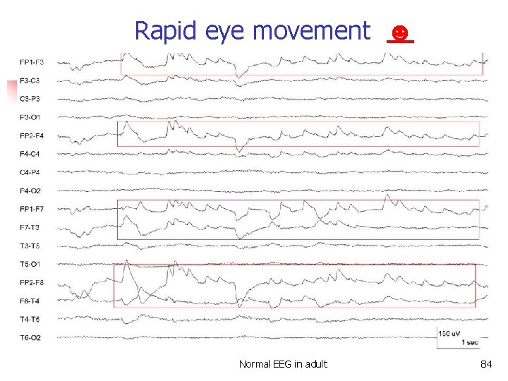 Rapid eye movement ☻ Rapid eye movement Normal EEG in adult 84 