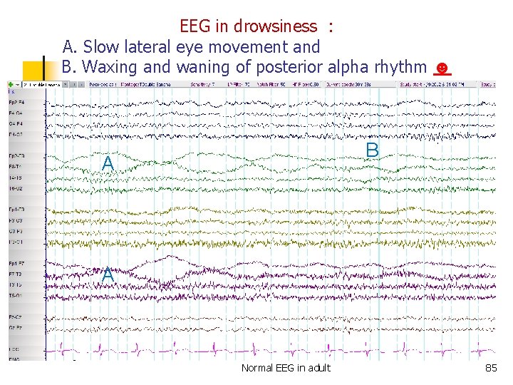 Talk n n n Definition of normalabnormal EEG