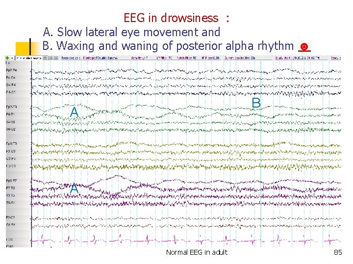 EEG in drowsiness : A. Slow lateral eye movement and B. Waxing and waning