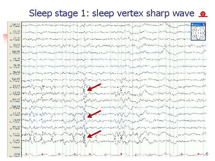 Sleep stage 1: sleep vertex sharp wave ☻ Normal EEG in adult 86 