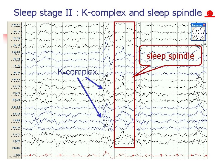 Sleep stage II : K-complex and sleep spindle ☻ sleep spindle K-complex Normal EEG