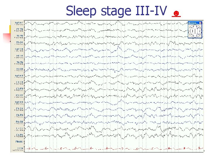 Sleep stage III-IV Normal EEG in adult ☻ 89 