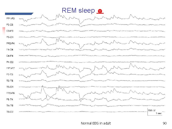 REM sleep ☻ Stage REM ☻ Normal EEG in adult 90 