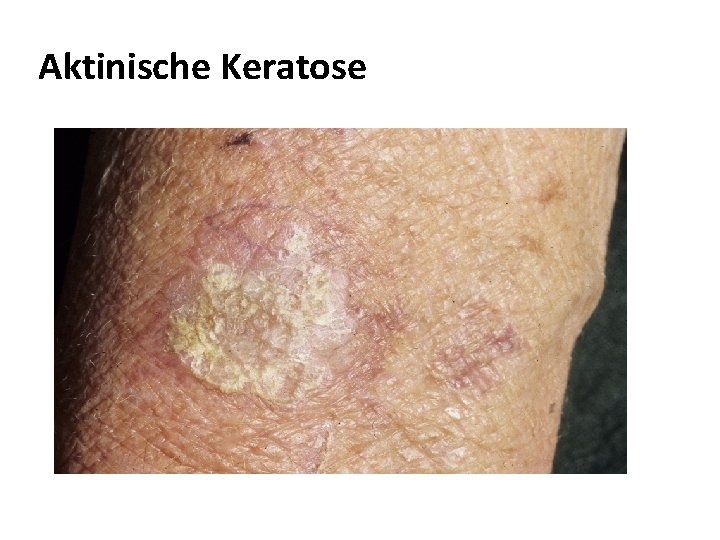 Aktinische Keratose 