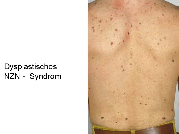 Dysplastisches NZN - Syndrom 