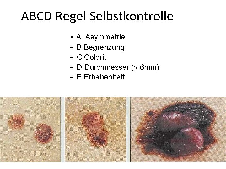 ABCD Regel Selbstkontrolle -A - Asymmetrie B Begrenzung C Colorit D Durchmesser ( 6