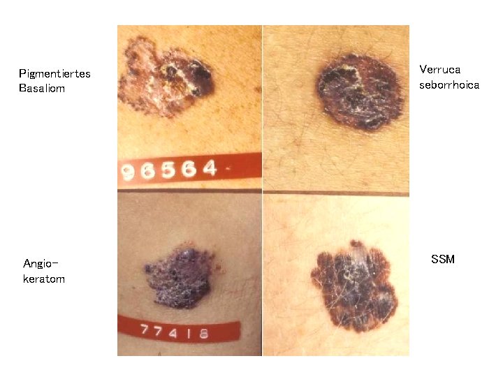 Pigmentiertes Basaliom Angiokeratom Verruca seborrhoica SSM 