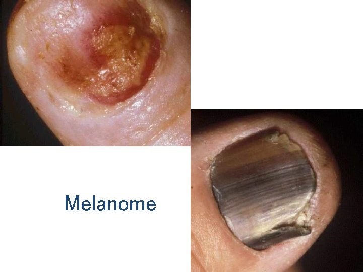 Melanome 