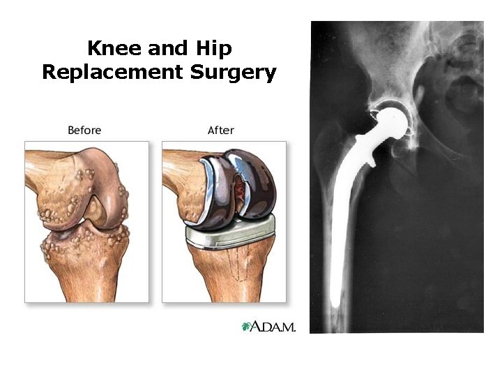 Knee and Hip Replacement Surgery 