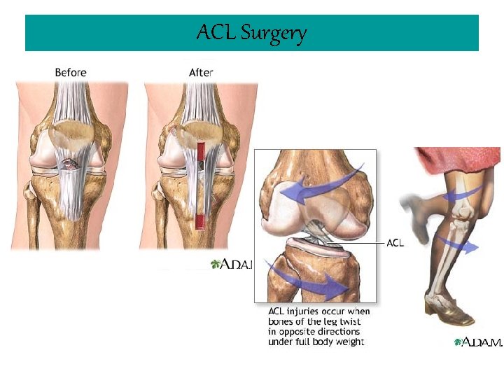 ACL Surgery 