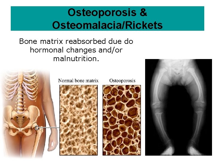 Osteoporosis & Osteomalacia/Rickets Bone matrix reabsorbed due do hormonal changes and/or malnutrition. 