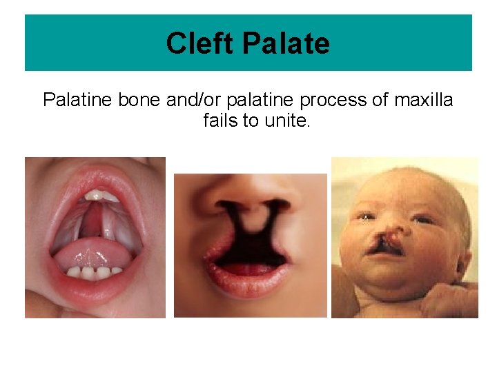 Cleft Palate Palatine bone and/or palatine process of maxilla fails to unite. 