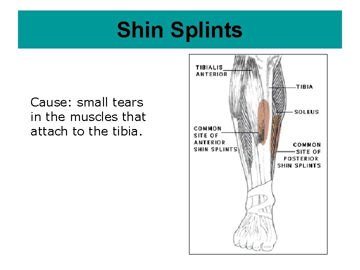 Shin Splints Cause: small tears in the muscles that attach to the tibia. 