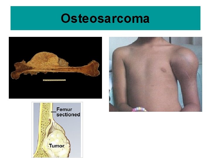 Osteosarcoma 