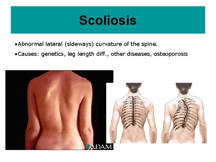 Scoliosis • Abnormal lateral (sideways) curvature of the spine. • Causes: genetics, leg length