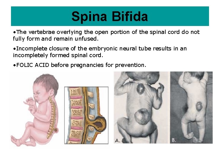 Spina Bifida • The vertebrae overlying the open portion of the spinal cord do