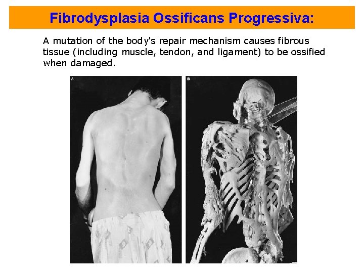 Fibrodysplasia Ossificans Progressiva: A mutation of the body's repair mechanism causes fibrous tissue (including