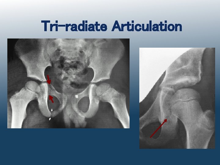 Tri-radiate Articulation 