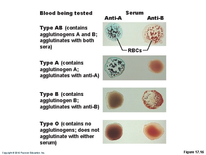 Blood being tested Type AB (contains agglutinogens A and B; agglutinates with both sera)