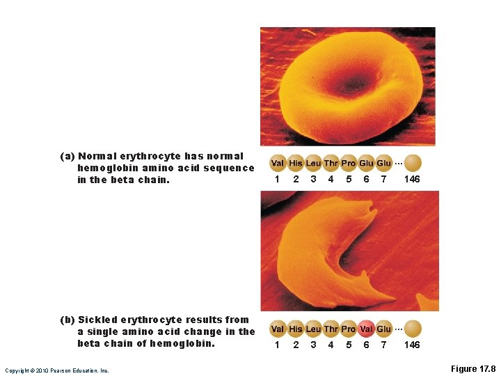 (a) Normal erythrocyte has normal hemoglobin amino acid sequence in the beta chain. 1