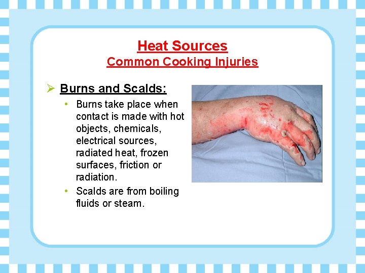 Heat Sources Common Cooking Injuries Ø Burns and Scalds: • Burns take place when