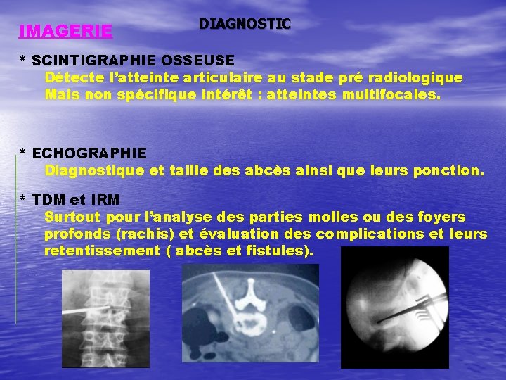 IMAGERIE DIAGNOSTIC * SCINTIGRAPHIE OSSEUSE Détecte l’atteinte articulaire au stade pré radiologique Mais non