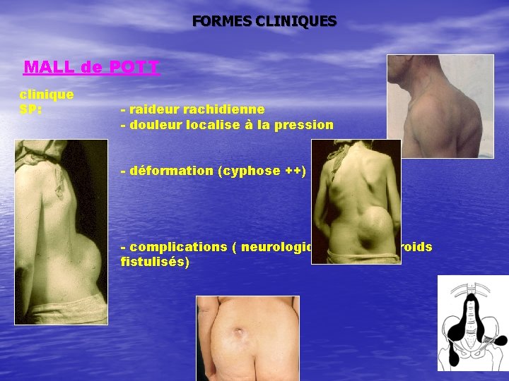 FORMES CLINIQUES MALL de POTT clinique SP: - raideur rachidienne - douleur localise à