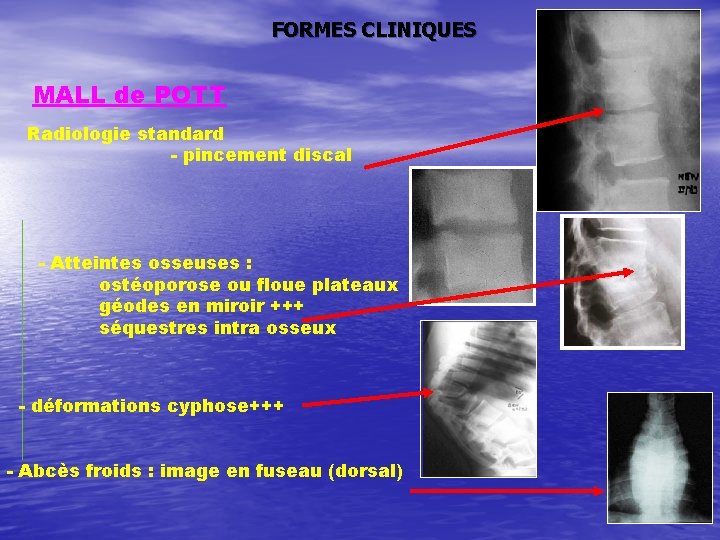 FORMES CLINIQUES MALL de POTT Radiologie standard - pincement discal - Atteintes osseuses :