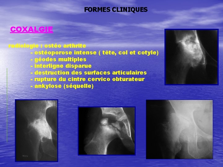 FORMES CLINIQUES COXALGIE radiologie : ostéo arthrite - ostéoporose intense ( tête, col et