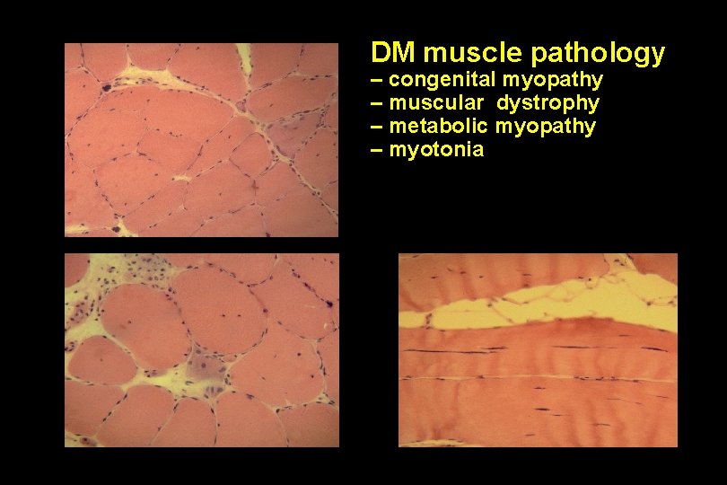 DM muscle pathology – congenital myopathy – muscular dystrophy – metabolic myopathy – myotonia