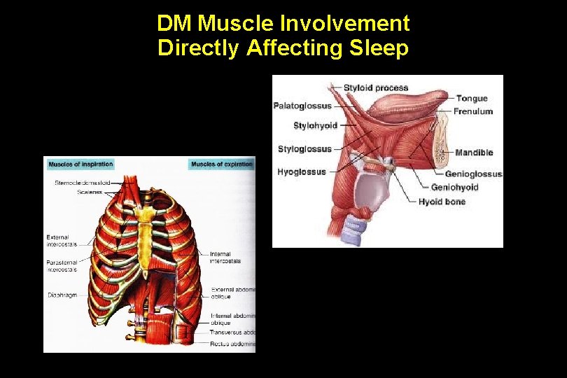 DM Muscle Involvement Directly Affecting Sleep 