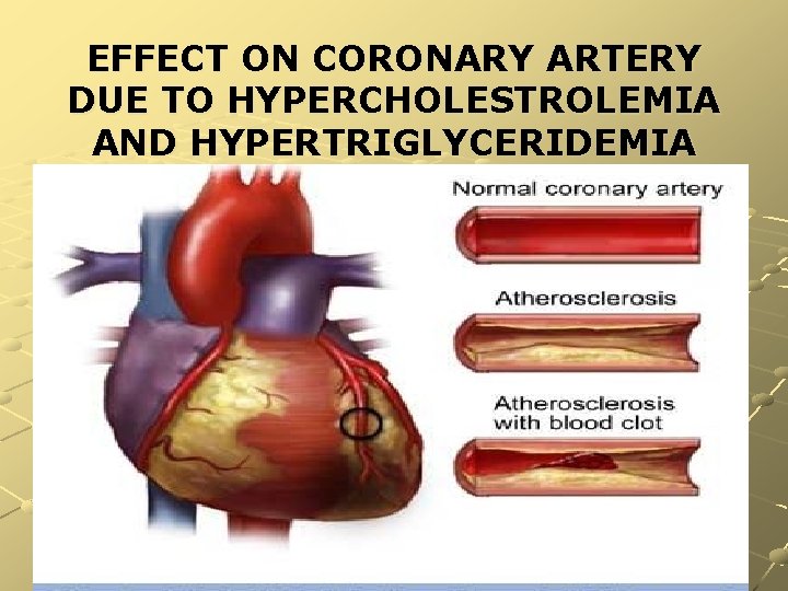 EFFECT ON CORONARY ARTERY DUE TO HYPERCHOLESTROLEMIA AND HYPERTRIGLYCERIDEMIA 