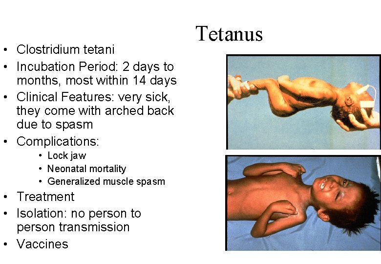  • Clostridium tetani • Incubation Period: 2 days to months, most within 14