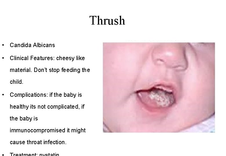 Thrush • Candida Albicans • Clinical Features: cheesy like material. Don’t stop feeding the