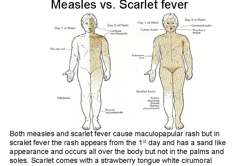 Measles vs. Scarlet fever Both measles and scarlet fever cause maculopapular rash but in