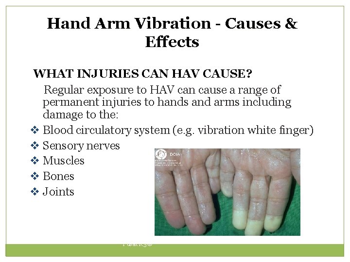 Hand Arm Vibration - Causes & Effects WHAT INJURIES CAN HAV CAUSE? Regular exposure