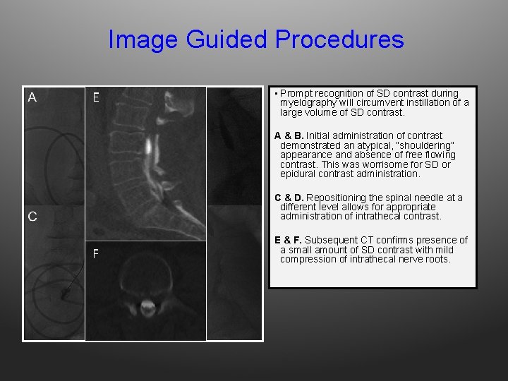Image Guided Procedures E • Prompt recognition of SD contrast during myelography will circumvent