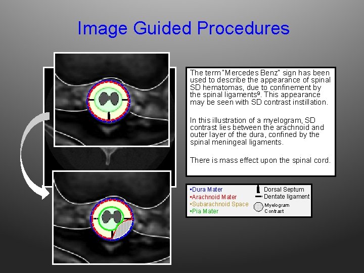 Image Guided Procedures The term “Mercedes Benz” sign has been used to describe the