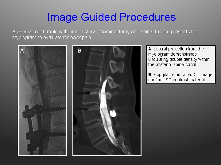 Image Guided Procedures A 39 year-old female with prior history of laminectomy and spinal