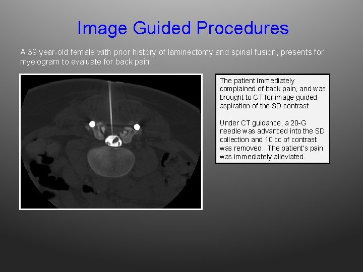Image Guided Procedures A 39 year-old female with prior history of laminectomy and spinal