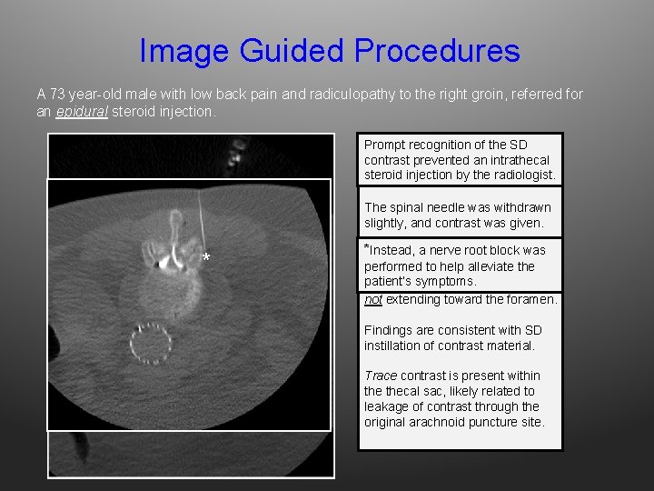 Image Guided Procedures A 73 year-old male with low back pain and radiculopathy to