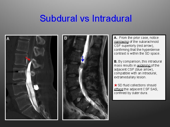 Subdural vs Intradural A B A. From the prior case, notice narrowing of the