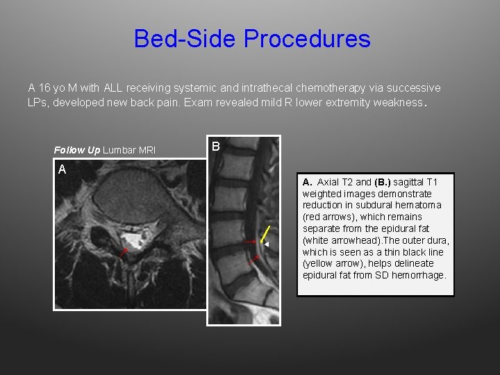Bed-Side Procedures A 16 yo M with ALL receiving systemic and intrathecal chemotherapy via
